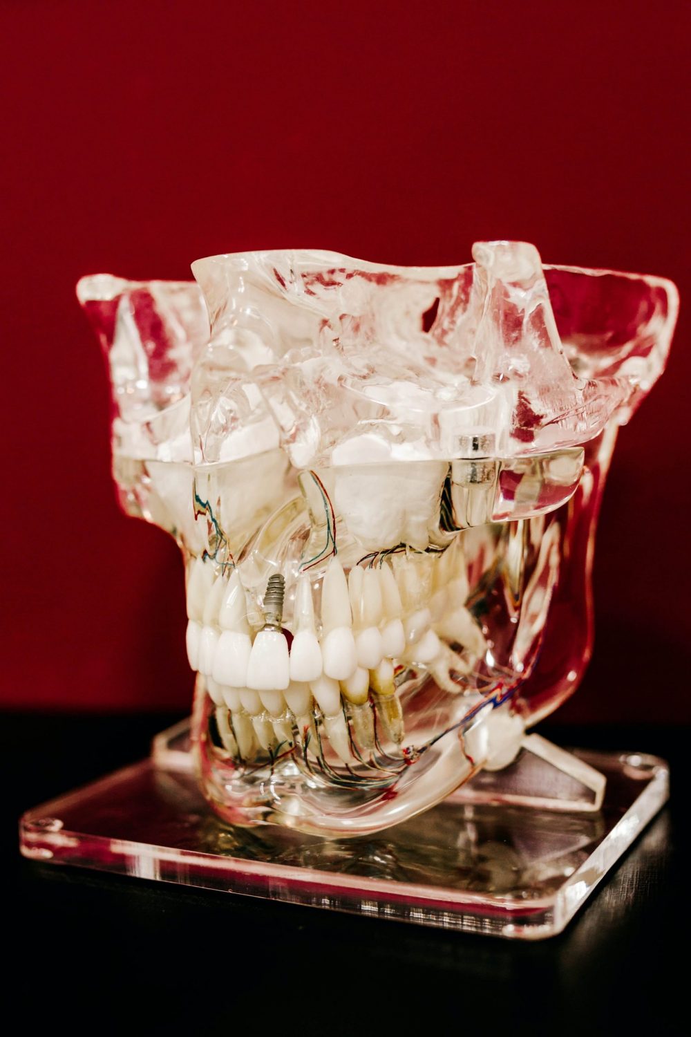 Ile kosztują implanty stomatologiczne - co warto wiedzieć?