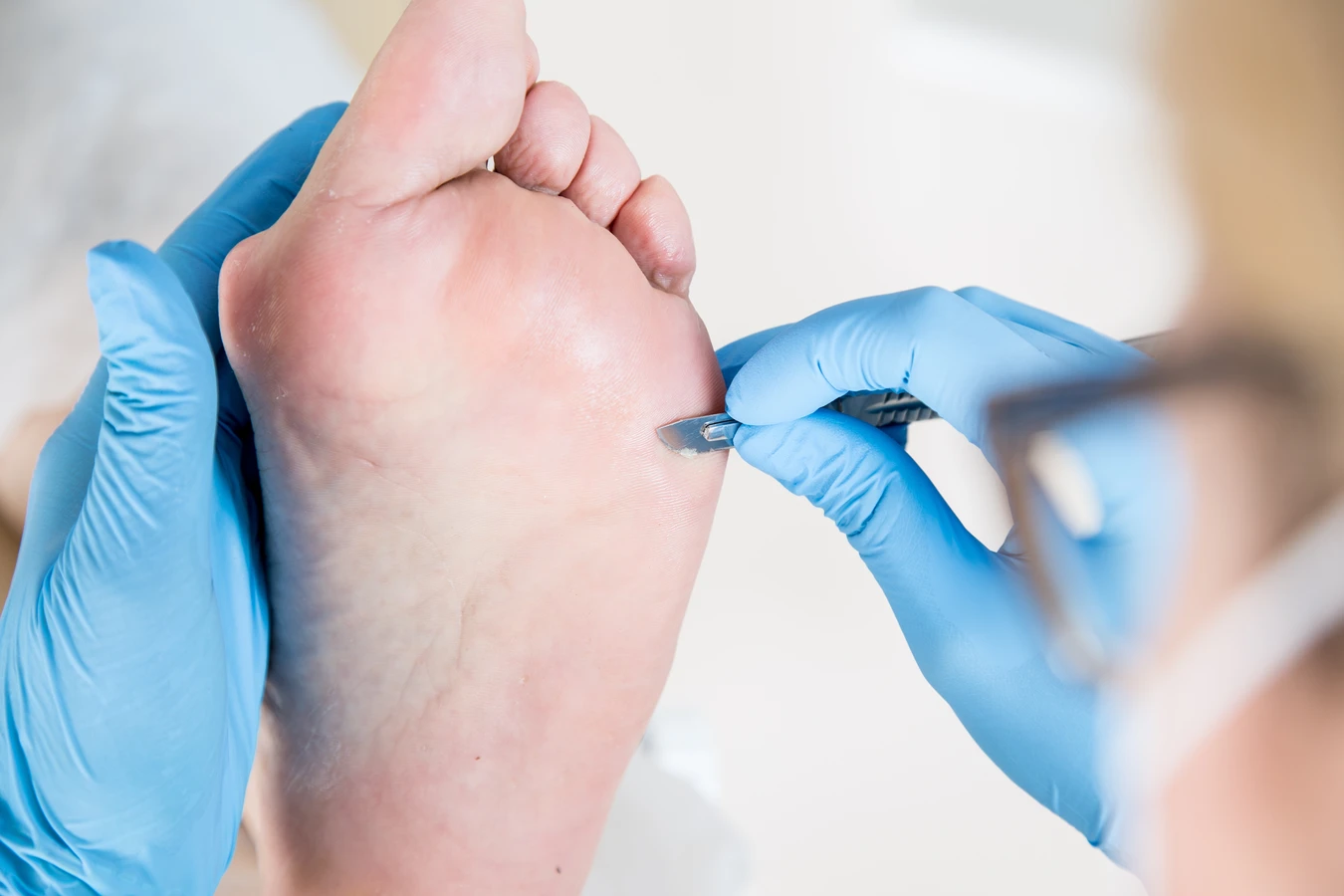 Jak podolog usuwa odcisk?