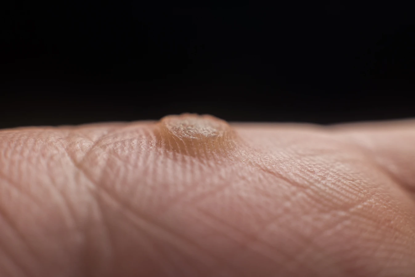 Jak wygląda korzeń kurzajki?