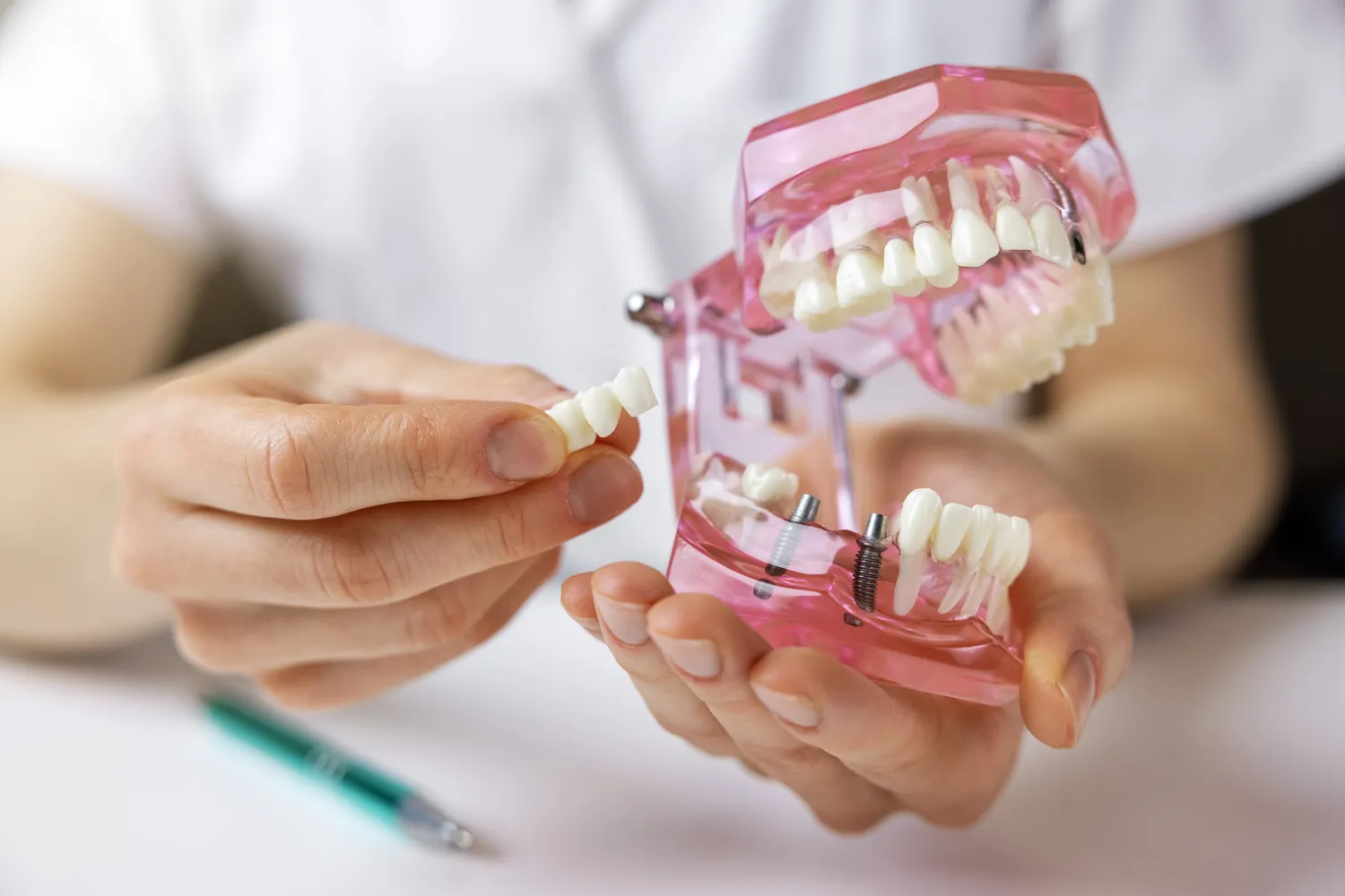 Rodzaje implantów zębowych