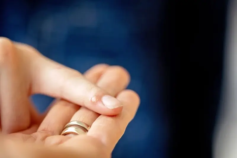 Co na kurzajki dla dzieci?