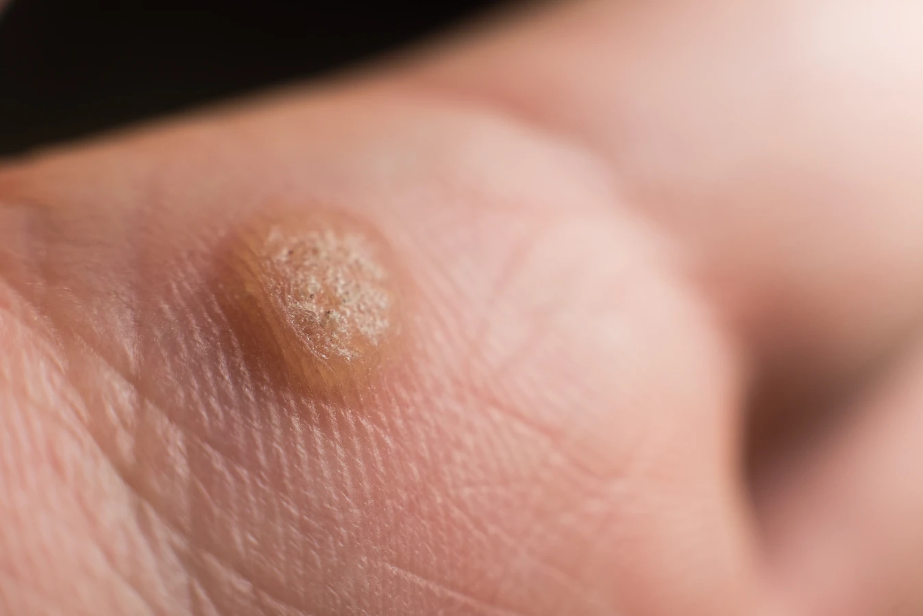 Kurzajki podolog czy dermatolog?